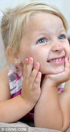 Bu qız "təlxək burnu" ilə doğulub - İllər sonrakı HALI - FOTO