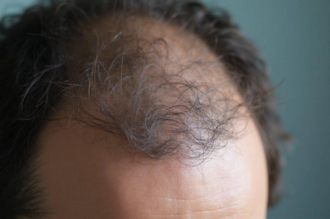 Saç tökülməsi stresdənmi olur? – Həkimlər səbəbləri açıqladı