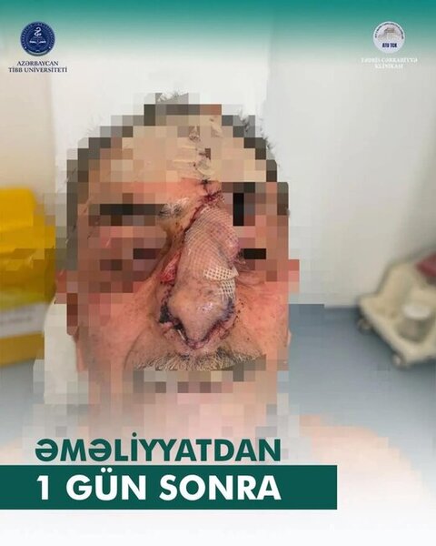İt dişləməsi nəticəsində burnunu itirən xəstəyə yeni burun formalaşdırıldı - Azərbaycanda unikal əməliyyat