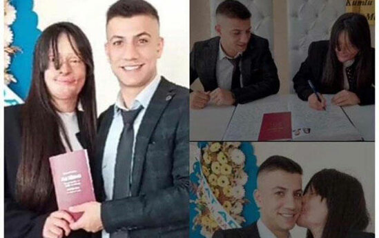 Üzünü yandırıb, onu kor edən adama ərə getdi - FOTO
