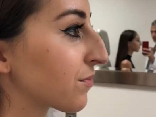 Burun əməliyyatı ilə tamamilə dəyişdi - Rekord qıran VİDEO