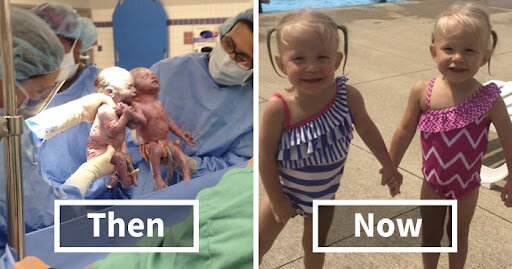 Doğulanda əl-ələ tutan əkizlər indi də ayrılmırlar - FOTOLAR