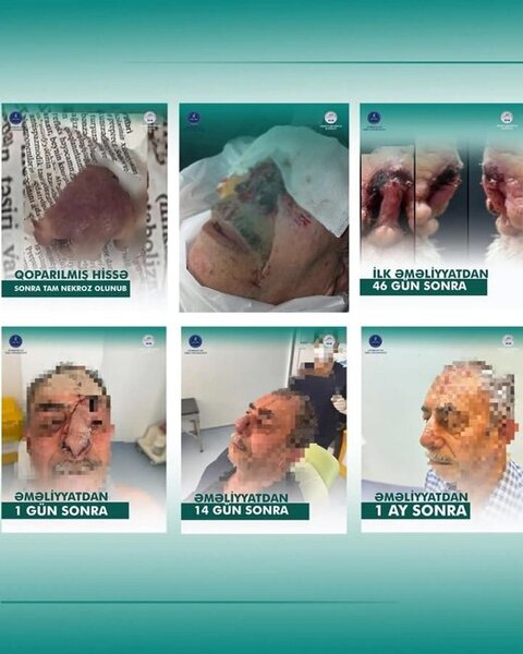 İt dişləməsi nəticəsində burnunu itirən xəstəyə yeni burun formalaşdırıldı - Azərbaycanda unikal əməliyyat