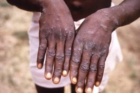 "Meymun çiçəyi" Rusiya laboratoriyasında hazırlanıb" - Britaniya nəşri