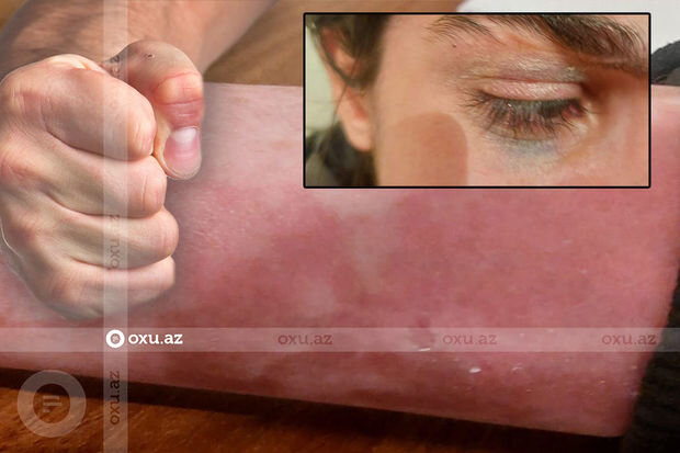 Bakıda ailəsi tərəfindən döyülən məktəbli qız sığınacağa yerləşdirildi - YENİLƏNİB + FOTO