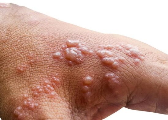 Avropada meymunçiçəyi virusundan ilk ölüm qeydə alındı