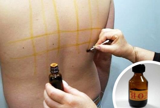 "Yod setkası" nəyi müalicə edir? - Sınanmış üsulun əks-təsirləri