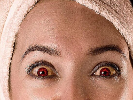 Gözlərin bərəlməsi hansı xəstəliyin əlamətidir - Endokrinoloqdan AÇIQLAMA