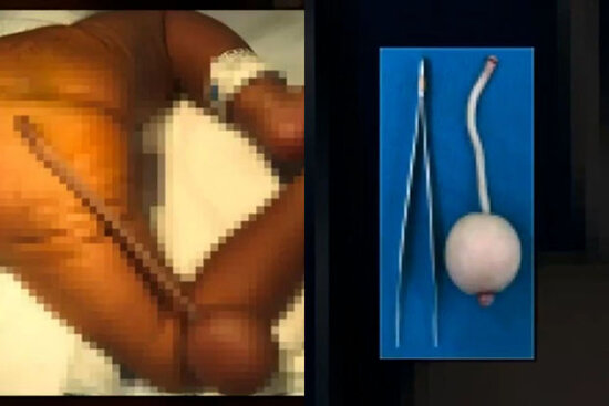 Braziliyada quyruqlu uşaq doğuldu - VİDEO