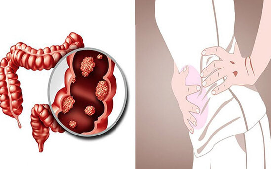Bağırsaq xərçəngi olduğunuzu göstərən - 8 ƏLAMƏT