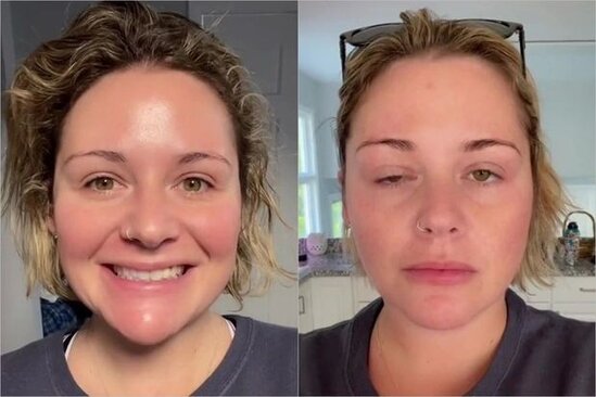 Botoks elətdirən qadının üzü iflic oldu - FOTO - VİDEO