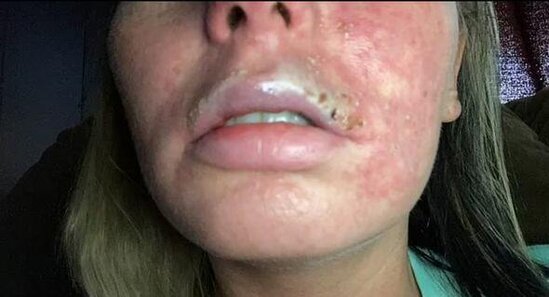 Dodağına gel doldurdu, dodağı çürüdü - FOTO