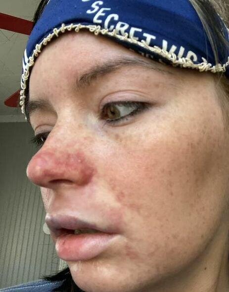 Dodağına gel doldurdu, dodağı çürüdü - FOTO