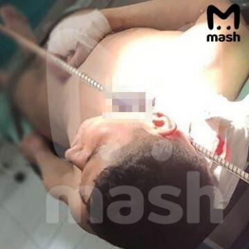 Gəncin boynundan 1,5 metrlik armatur çıxarıldı - FOTO