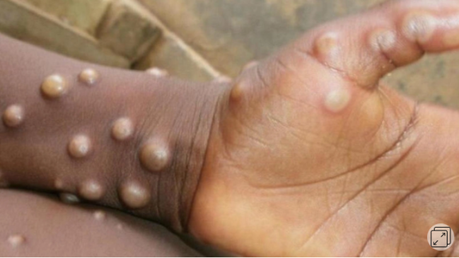 Cinsi azlıqlarda "meymun çiçəyi" virusu aşkarlandı