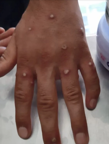 İstanbulda meymunçiçəyi təşvişi - FOTO