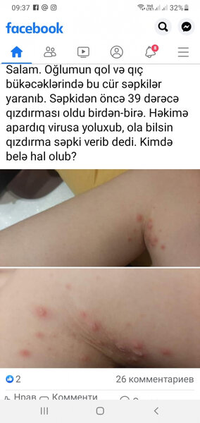 Azərbaycanda uşaqlar arasında yayılan xəstəlik meymunçiçəyidir? - Professordan VACİB AÇIQLAMA