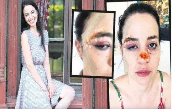 Tanınmış aktrisanın üzünü it parçaladı - 37 tikiş vuruldu - FOTO