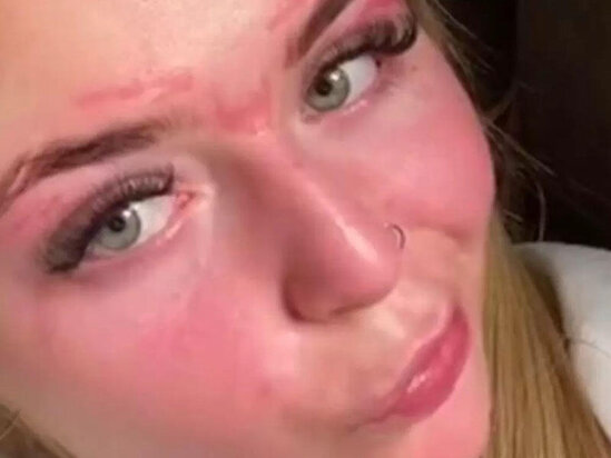 Toydan bir gün əvvəl uğursuz qaş korreksiyası etdirən qız tanınmaz hala düşdü