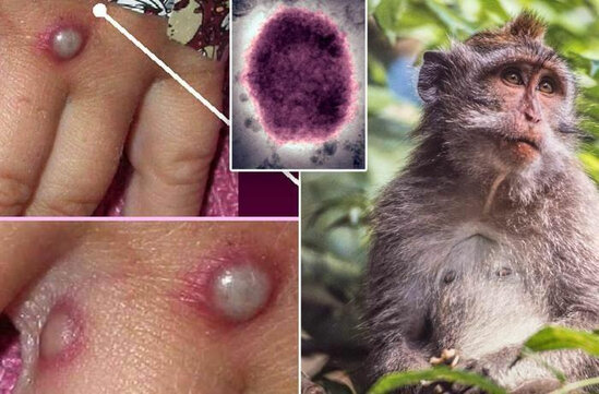 Meymunçiçəyi xəstəliyinin diaqnostika qaydaları açıqlanıb