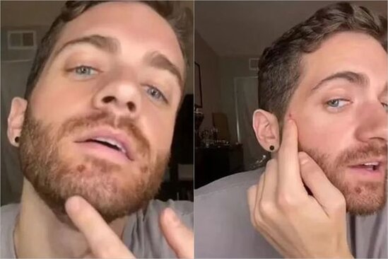 Xəstəlikdən sağalan məşhur aktyor meymunçiçəyi ilə bağlı təcrübəsini bölüşdü - FOTO/VİDEO