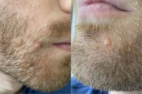 Xəstəlikdən sağalan məşhur aktyor meymunçiçəyi ilə bağlı təcrübəsini bölüşdü - FOTO/VİDEO