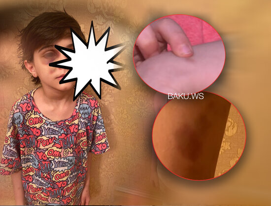 Analarının sevgilisi tərəfindən döyülən uşaqlar: Qoluna siqaret basıbmış... - VİDEO