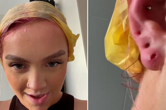 Ucuz sırğaların acı sonluğu: Qulağının bir parçası çürüyüb düşdü - VİDEO