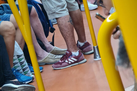 Meymunçiçəyinə yoluxan metroda aşkar edildi