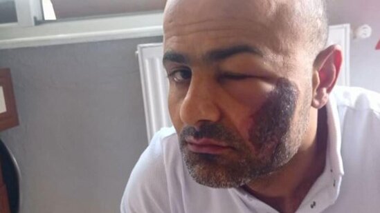 Lazer epilyasiyası etdirən kişinin başına iş gəldi