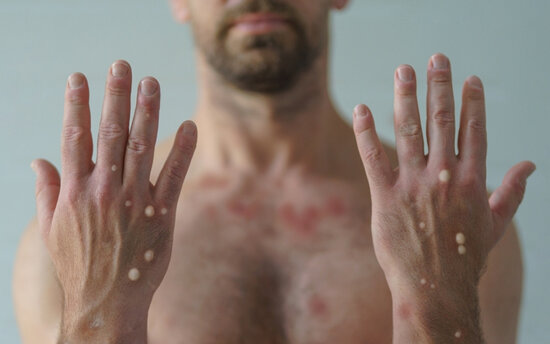 Meymunçiçəyi təhlükəsi ilə bağlı baş infeksionistdən XƏBƏRDARLIQ