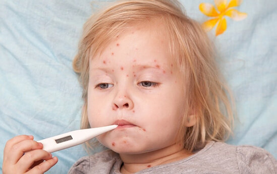 Qızılcaya yoluxmada kəskin artım var - ÜST