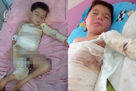 Balaca Ayxanın üzərinə qaynar su tökülüb: Anası dərman almaq üçün pul tapmır - FOTO/VİDEO