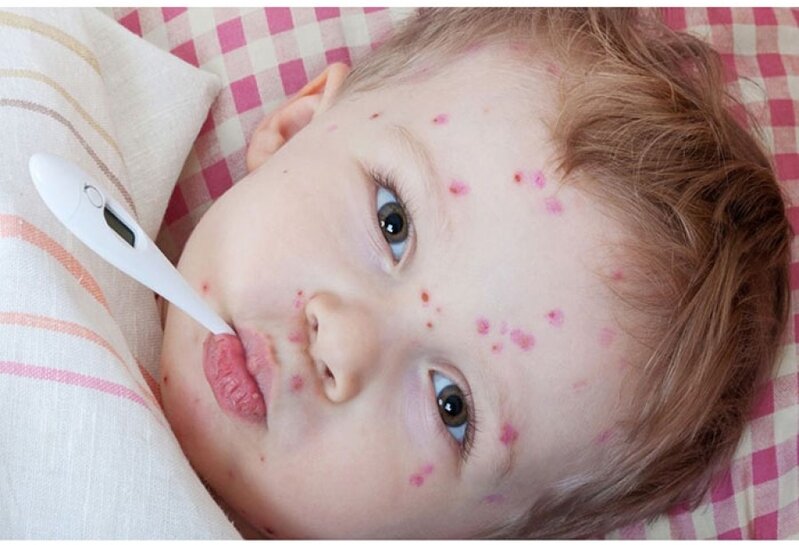 Qızılcanın yeni variantları yaranır? - AÇIQLAMA+VİDEO