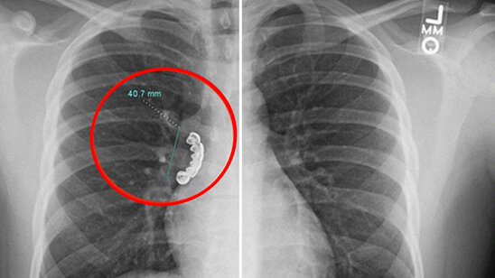 22 yaşlı gəncin protez dişi ağ ciyərinə batdı - FOTO