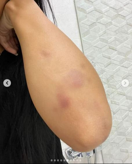 Sevgilisi tərəfindən döyülən Razi: "Məni 13-cü mərtbədən aşağı atmaq istədi" - FOTO