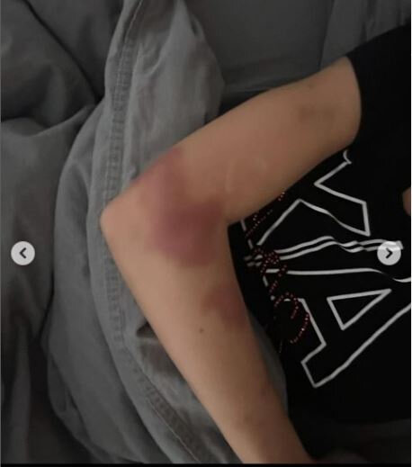 Sevgilisi tərəfindən döyülən Razi: "Məni 13-cü mərtbədən aşağı atmaq istədi" - FOTO