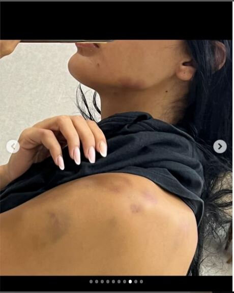 Sevgilisi tərəfindən döyülən Razi: "Məni 13-cü mərtbədən aşağı atmaq istədi" - FOTO