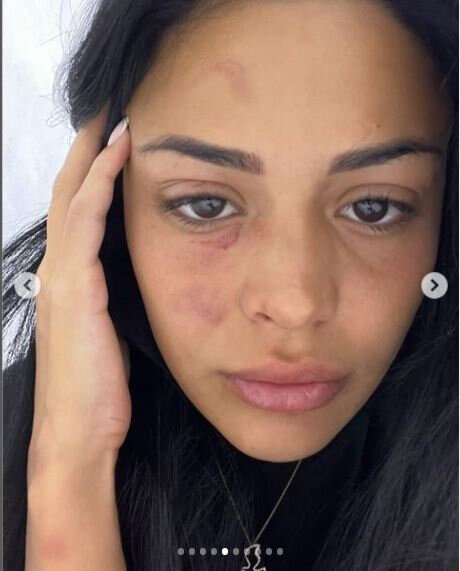 Sevgilisi tərəfindən döyülən Razi: "Məni 13-cü mərtbədən aşağı atmaq istədi" - FOTO