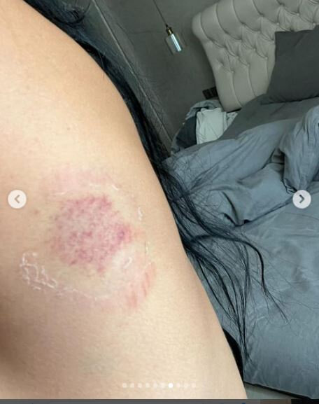 Sevgilisi tərəfindən döyülən Razi: "Məni 13-cü mərtbədən aşağı atmaq istədi" - FOTO