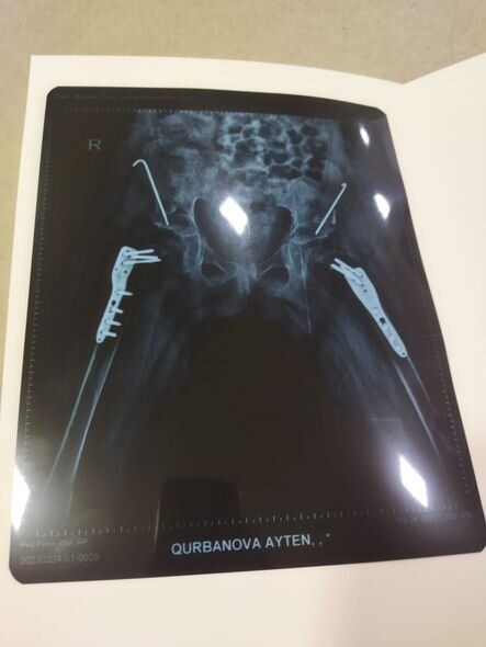 Üç dəfə əməliyyat keçirmiş Aytənin yardıma ehtiyacı var - FOTO