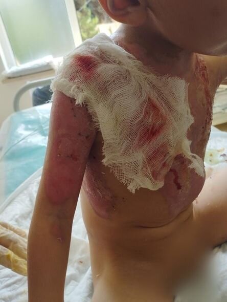 Dəhşətli faciə ilə üzləşən iki azyaşlı qardaşın yardımınıza ehtiyacı var - FOTO