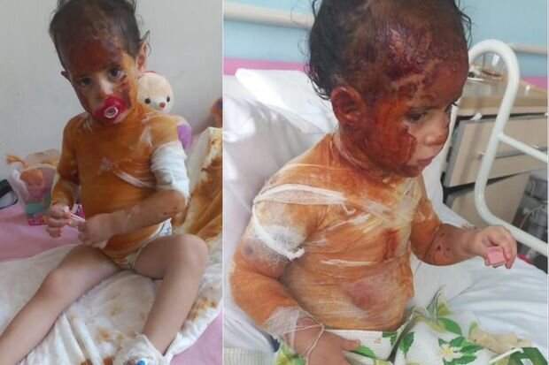 Başından aşağı qaynar su tökülən 3 yaşlı Xədicənin sizin köməyinizə ehtiyacı var - FOTO