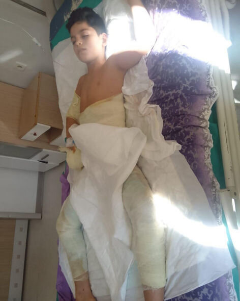 Bütün bədəni yanan 11 yaşlı Sabirin dəstəyə ehtiyacı var: Müalicə üçün pulları yoxdur - FOTO/VİDEO