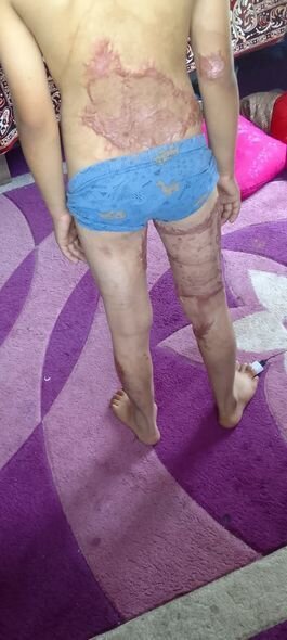 Bütün bədəni yanan 11 yaşlı Sabirin dəstəyə ehtiyacı var: Müalicə üçün pulları yoxdur - FOTO/VİDEO