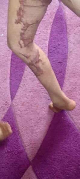 Bütün bədəni yanan 11 yaşlı Sabirin dəstəyə ehtiyacı var: Müalicə üçün pulları yoxdur - FOTO/VİDEO