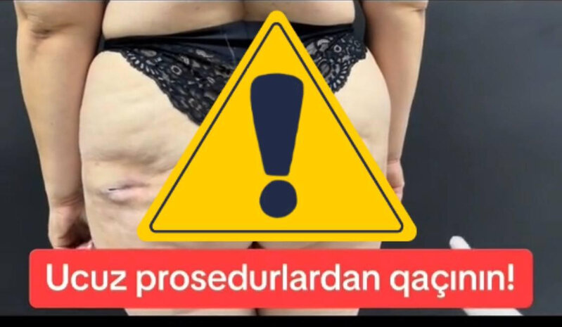 Bakıda ombadikləşdirmə əməliyyatı etdirən qadının bədəni yırtıldı - Bu hala düşdü - FOTO/VİDEO