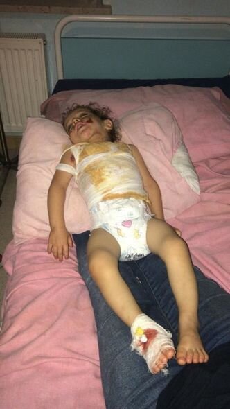 Bədəni yanan 2 yaşlı Ayanın dəstəyə ehtiyacı var: İmkan olmadığı üçün müalicə yarımçıq qalıb - FOTO