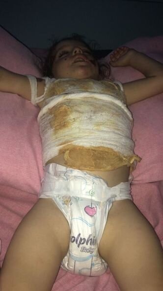 Bədəni yanan 2 yaşlı Ayanın dəstəyə ehtiyacı var: İmkan olmadığı üçün müalicə yarımçıq qalıb - FOTO