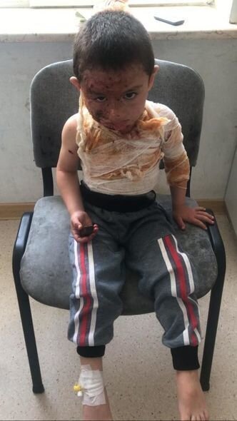 Dörd yaşlı Rəvanın başından aşağı qaynar su tökülüb - FOTO